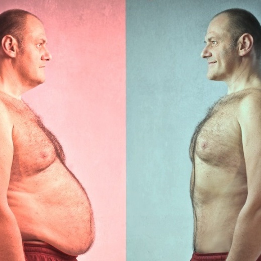 абдоминопластика у мужчины, до и после