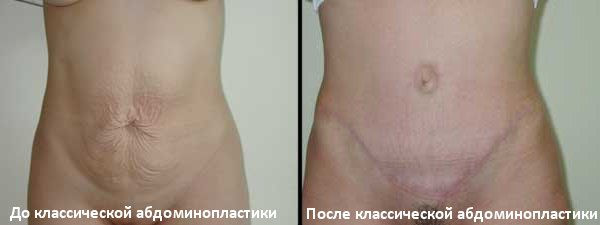 На фото - пациентка до и после классической абдоминопластики