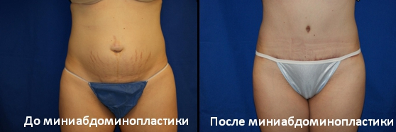 На фото - пациентка до и после миниабдоминопластики