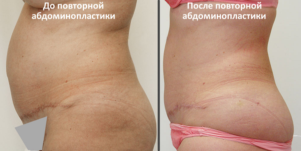 На фото - пациентка до и после повторной абдоминопластики